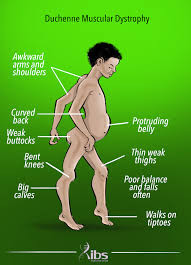 muscular Dystrophy